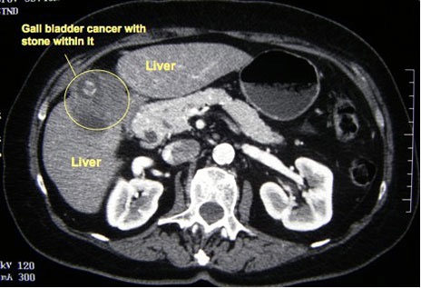 CT scan gall bladder